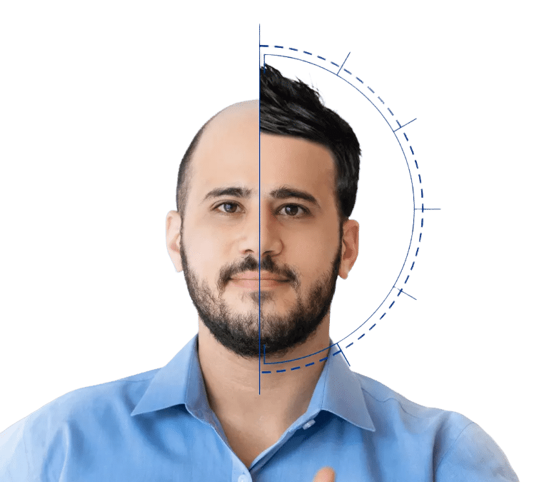 کاشت مو VIP در تهران