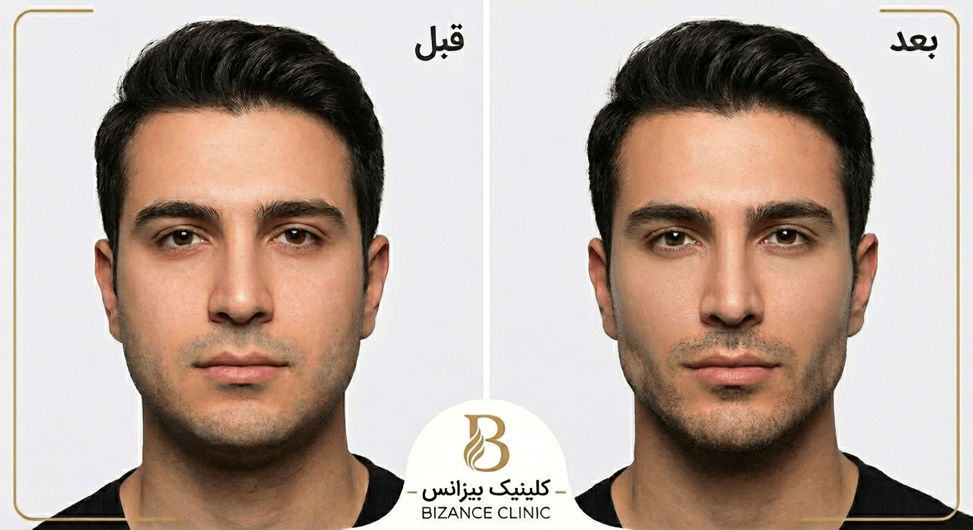 زاویه سازی صورت آقایان کلینیک بیزانس